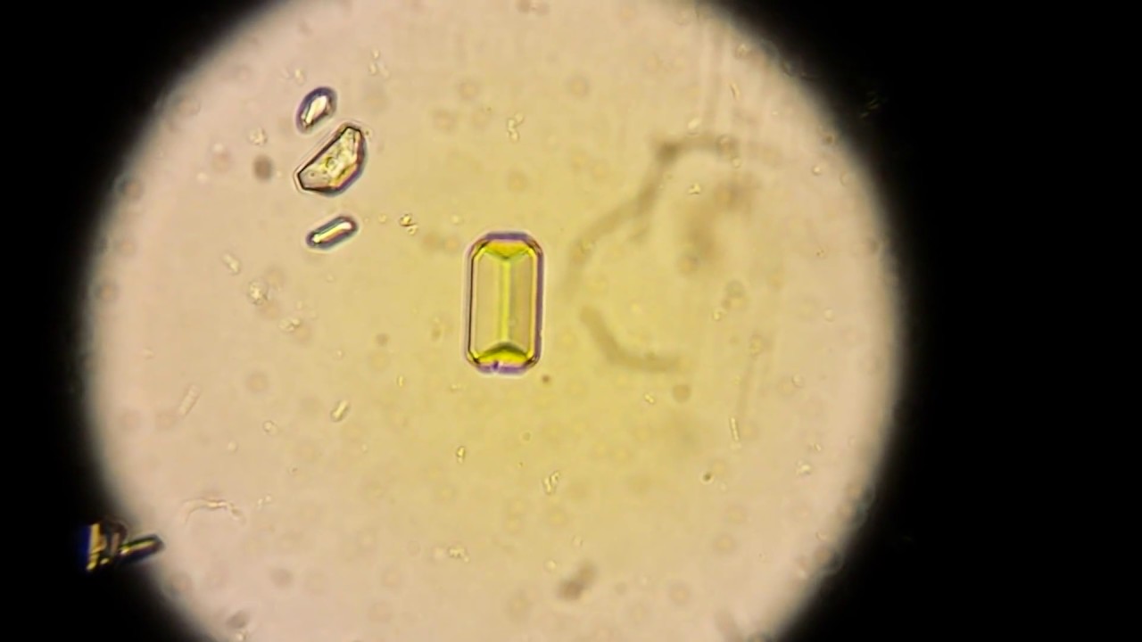 Моча слизь 3. Микроскопия кала трипельфосфаты. Микроскопия осадка мочи трипельфосфаты. Кристаллы трипельфосфаты. Трипельфосфаты в моче осадок.