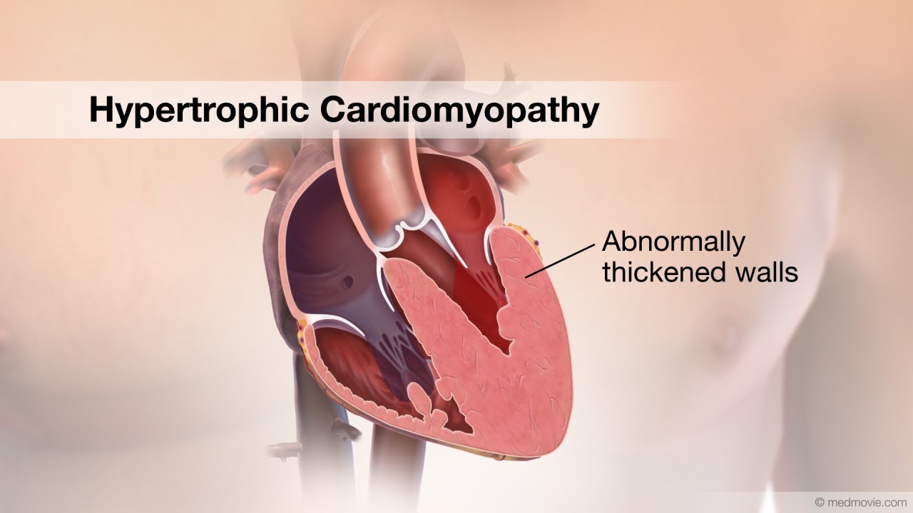 Миоэктомия. Гипертрофическая кардиомиопатия. Обструктивная и необструктивная кардиомиопатия. Симметричная кардиомиопатия.