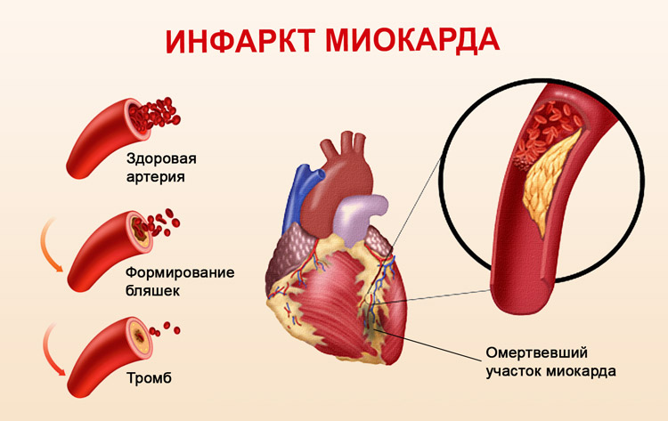 Оим это. Острый сердечный инфаркт миокарда. Строение сердца при инфаркте миокарда. Infrakt Miokart. Инфаркт миокарда доклад.